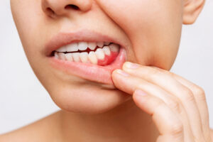 WPB Dental & Implants | Gum Disease Treatment: How to Protect Your Gums Before Small Problems Become Big Ones WPB Dental & Implants | Gum Disease Treatment: How to Protect Your Gums Before Small Problems Become Big Ones